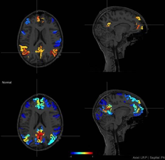 Example of brain activity